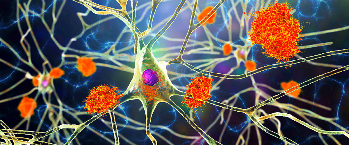 Neurons in Alzheimer's disease - illustration showing amyloid plaques